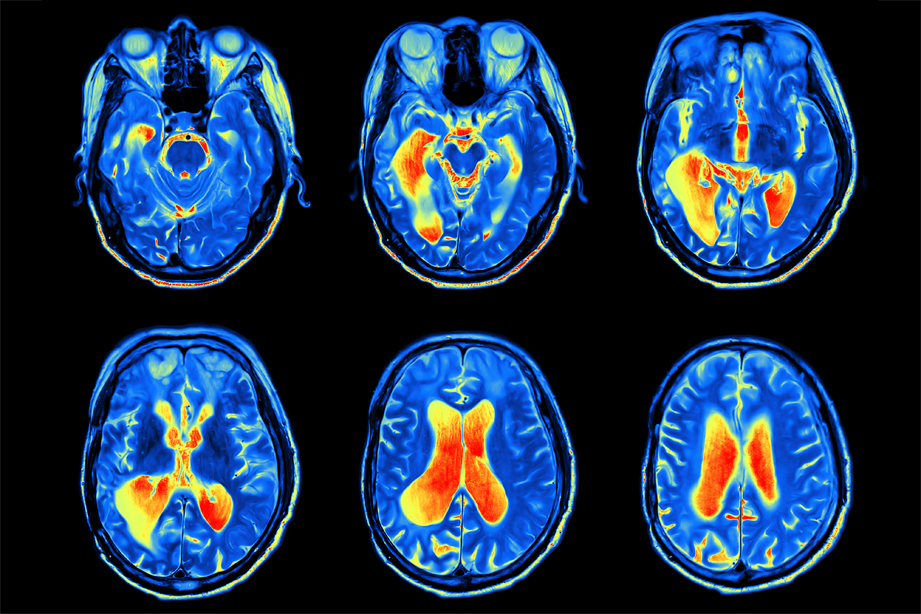 The ASD Demonstration Project: Neuroimaging and Function